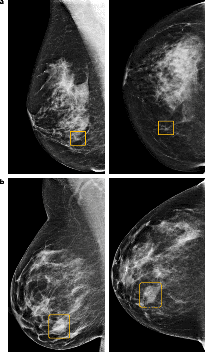 AI for Early Identification of Breast Cancer – Efficient and Accurate Diagnosis